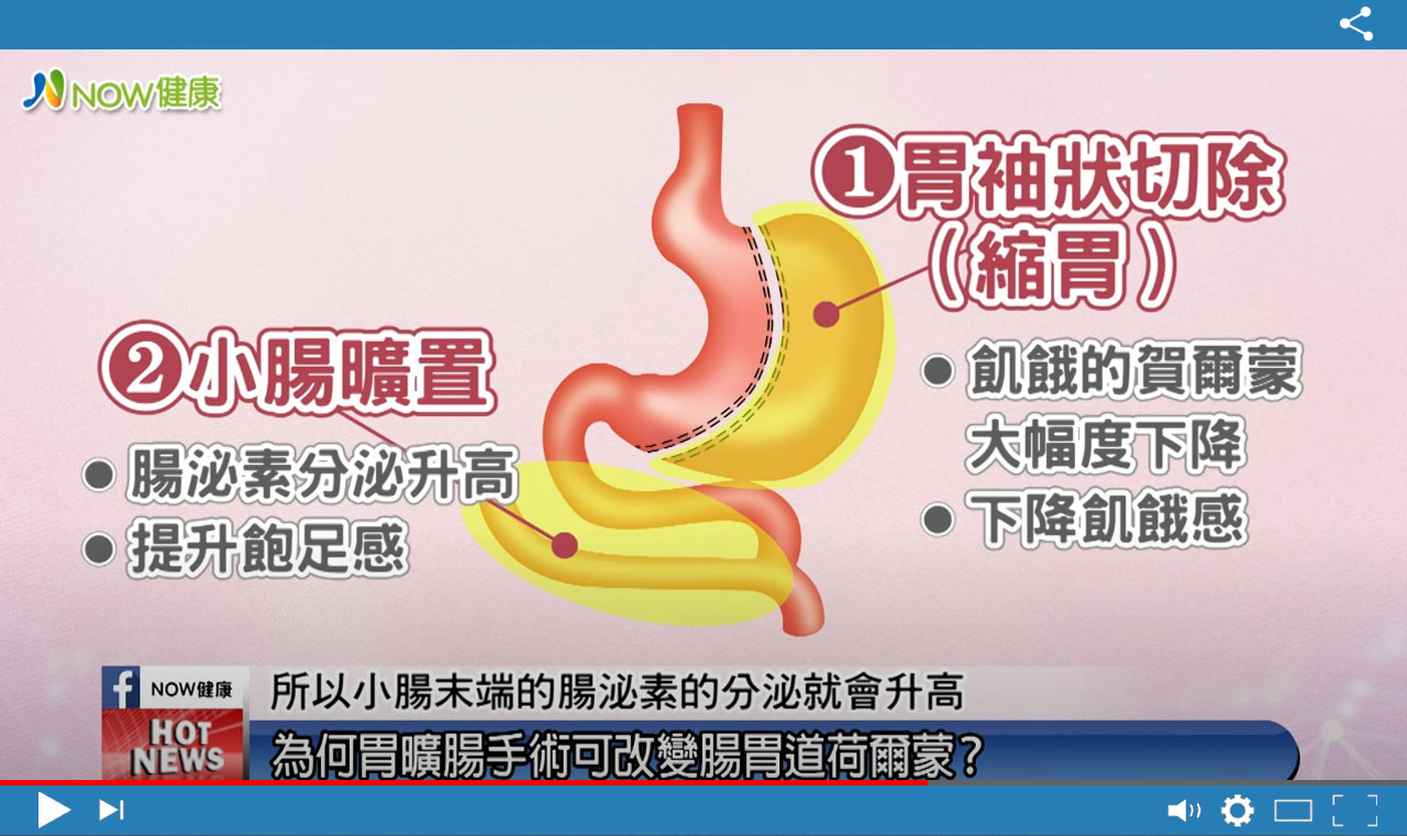 糖尿病減重_影片拍攝4